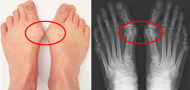 ▲ 엄지발가락이 과도하게 휘면서 관절이 튀어 나온 무지외반증 환자의 발과 X-ray 영상. ⓒ서울대병원