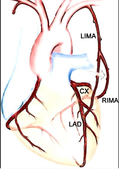 ▲ CABG 모식도.ⓒ세종충남대병원