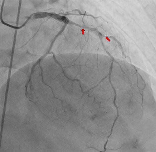 ▲ 관상동맥.ⓒ세종충남대병원