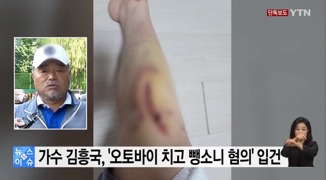 ▲ 지난 6일 가수 김흥국의 오토바이 접촉사고를 단독 보도한 YTN 방송 화면. 사진은 YTN과의 인터뷰에 응한 오토바이 운전자가 다친 다리 부위를 공개한 모습. ⓒYTN 화면 캡처