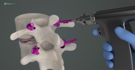 ▲ 척추에 SpinoPath를 장착해 나사못이 들어갈 구멍을 드릴링하는 모습.ⓒ세종충남대병원