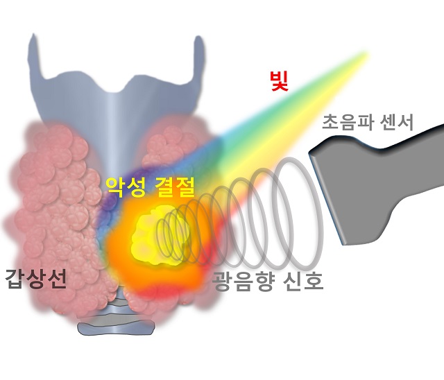 ▲ 악성 갑상선 결절에 레이저 빛을 조사할 때 발생한 광음향 신호를 초음파 센서로 획득하는 모식도.ⓒ포스텍