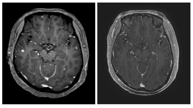 ▲ 타그리소 복용 전(좌)과 복용 3개월 후(우) CT 사진. 하얀색이던 암 조직이 확연히 줄어들었다. ⓒ연세의료원