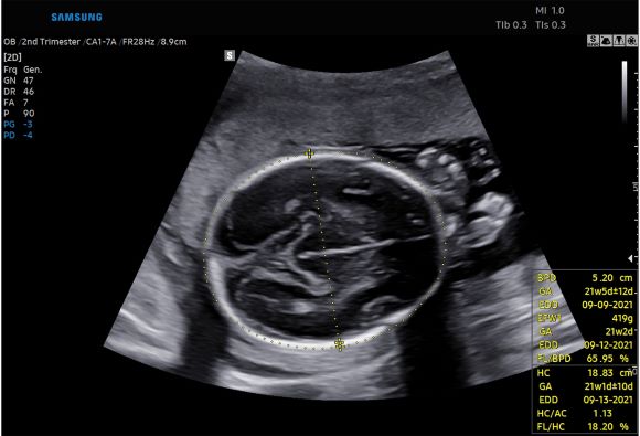 ▲ 태아 초음파 이미지에서 바이오메트리 솔루션을 활용해 태아의 머리를 자동으로 인지 및 측정하여 태아의 성장 정도를 보여주는 화면.ⓒ삼성메디슨