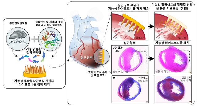 ▲ 심근경색 치료용 기능성 마이크로니들 접착 패치 모식도.ⓒ포스텍