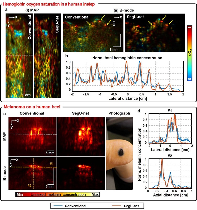 ▲ 딥러닝 모델(SegU-net)을 적용해 개선된 사람 족부 미세혈관 및 흑색종 영상.ⓒ포스텍