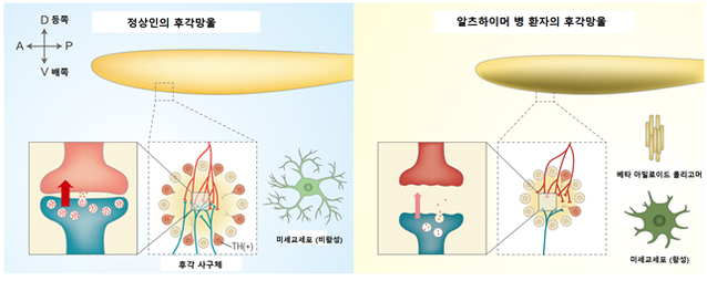 ▲ 알츠하이머 치매 환자의 후각망울 내 사구체 변화 개념도.ⓒDGIST