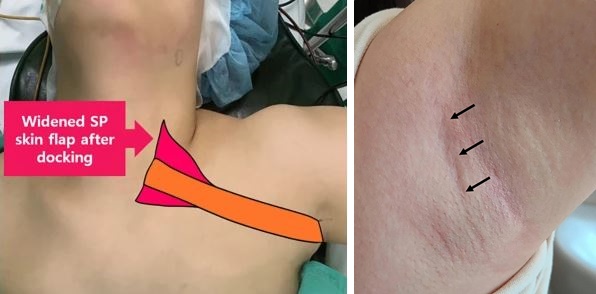 ▲ 겨드랑이를 절개해 갑상선암 수술을 진행하는 2단계 견인법 모습(왼쪽), 2단계 견인법을 통해 자연 주름에 절개 수술 후 6개월 경과한 갑상선암 환자 사례. ⓒ연세암병원