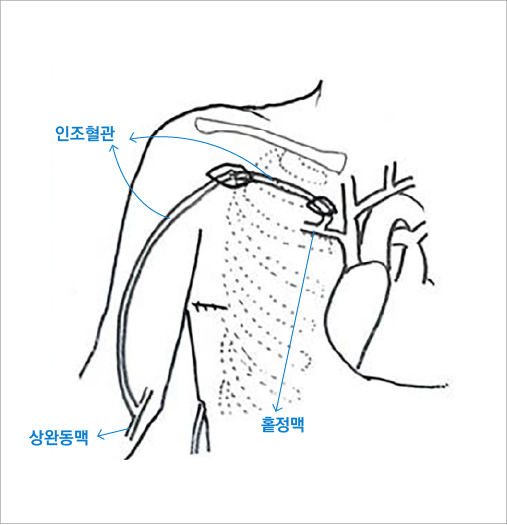 ▲ 상완동맥-홑정맥 동정맥루 모식도. ⓒ순천향대서울병원