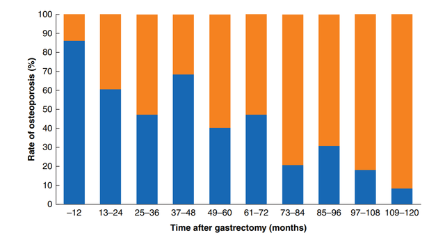 ▲ 위절제술 후 발생하는 골다골증 환자 현황. ⓒBJS(British Journal of Surgery)