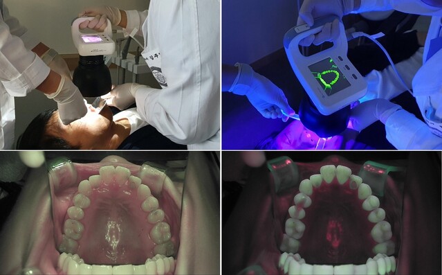 ▲ 큐레이캠 프로 장비로 치아를 선별검사 하는 모습. ⓒ경희대의료원