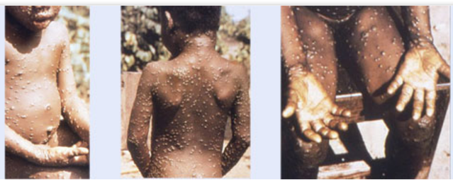 ▲ 원숭이두창에 감염된 아이의 모습. ⓒ미국 질병통제예방센터(CDC)