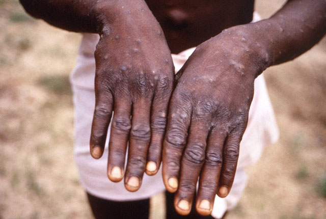 ▲ 1997년 아프리카에서 촬영한 원숭이두창 환자의 손. 손등에 수포성 발진이 보인다. ⓒ뉴시스 AP. 무단전재 및 재배포 금지.