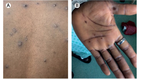 ▲ 원숭이두창 ⓒThe Lancet Infectious Disease