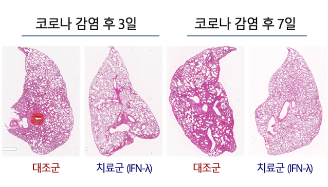 ▲ 인터페론 람다가 코로나19 바이러스를 수치를 낮추고 있다. ⓒ서울대병원