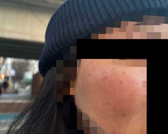 ▲ 싱가포르 국적 20대 여성이 지난 12일 오후 4시30분께 서울 동대문구의 횡단보도에서 모르는 남성에게 폭행당해 얼굴을 다친 모습. ⓒ뉴시스