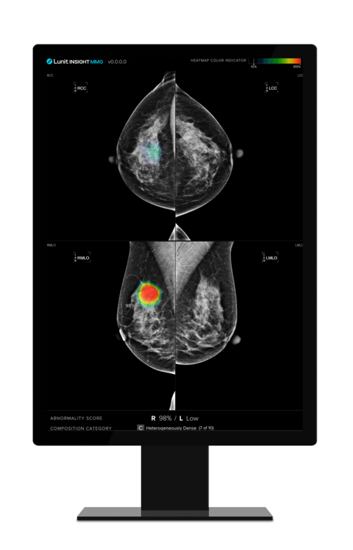 ▲ 유방촬영술 AI(인공지능) 영상진단 솔루션 '루닛 인사이트 MMG' 운용화면.ⓒ루닛