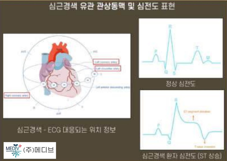 ▲ ㈜메디브가 개발한 심근경색 유관 관상동맥 및 심전도 표현.ⓒ충북테크노파크