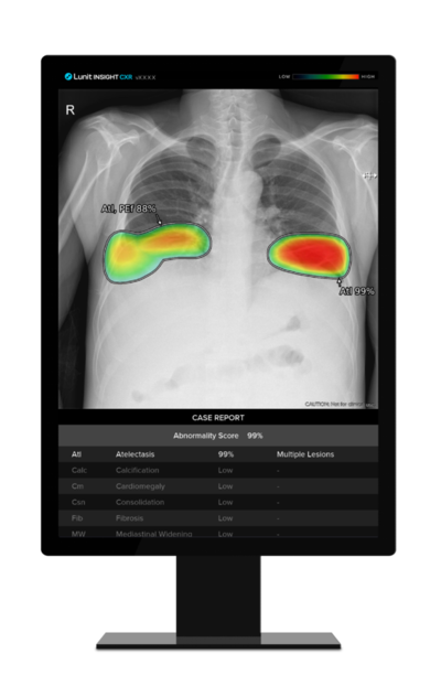 ▲ 루닛 흉부 엑스레이 AI 영상분석 솔루션 '루닛 인사이트 CXR' 
ⓒ루닛