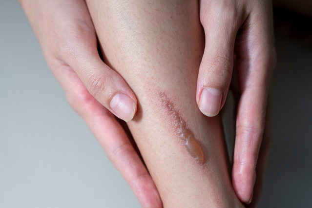 ▲ 비대성 흉터(비후성 반흔). ⓒ게티이미지뱅크