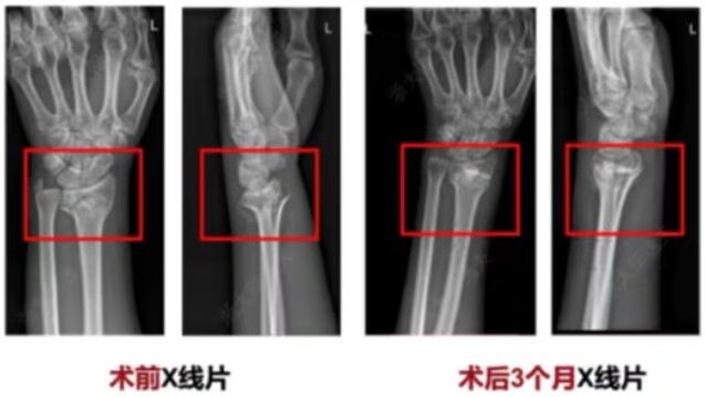 ▲ 골 접착제 'Bone-02'를 손목 골절에 사용한 전과 후 비교 사진. 출처=CCTV 갈무리ⓒCCTV