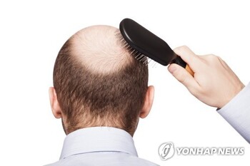 "탈모는 생존 문제" … 李 대통령 "건보 적용 검토" 지시에 탈모 관련주 '불기둥'